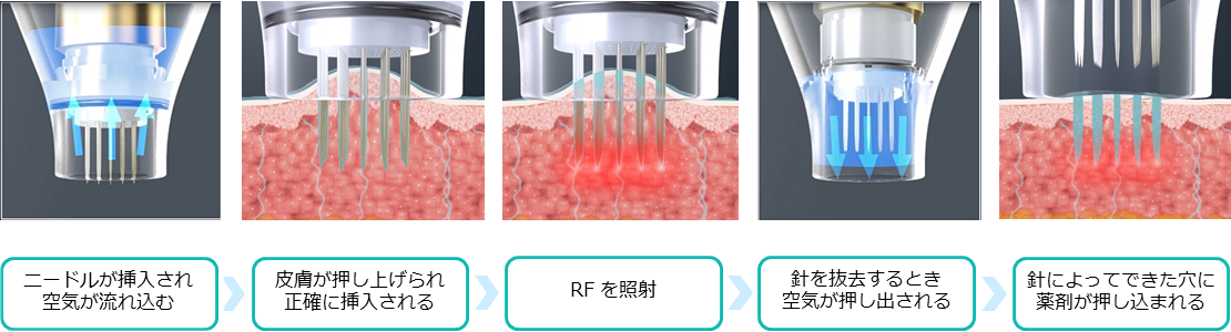 薬剤を均一に浸透させて治療を効果高めるドラッグデリバリーシステム