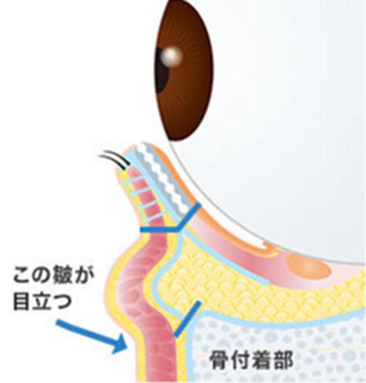 皮膚または粘膜に切開を入れ、眼窩隔膜の骨付着部を剥がす（深い下眼瞼のしわ＝骨付着による）