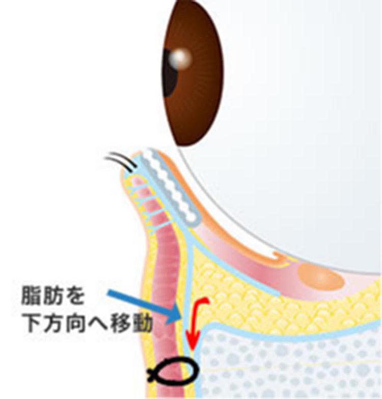 眼窩隔膜の骨付着部および脂肪を下方向に移動することで、脂肪突出の改善・しわの消失が得られる