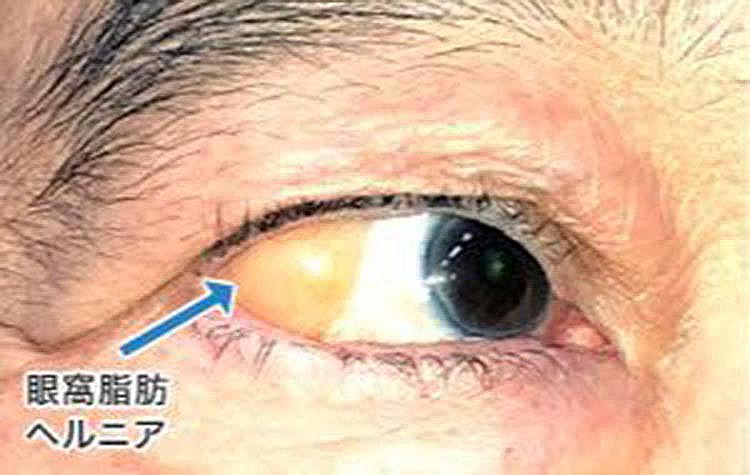皮膚または粘膜に切開を入れ、眼窩隔膜の骨付着部を剥がす（深い下眼瞼のしわ＝骨付着による）