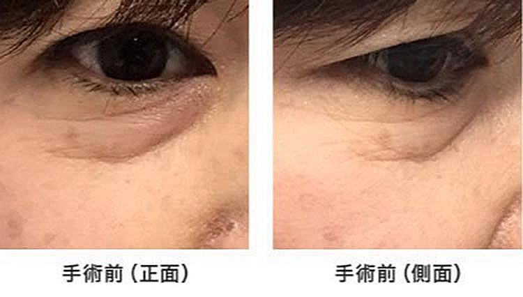 眼窩脂肪の突出による、下まぶたのたるみが目立ちます。この症例では、皮膚表面からアプローチし下まぶたの脂肪を処理しました。