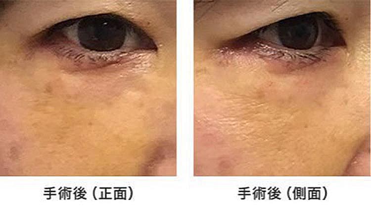 術後1週間の状態です。まだ少し内出血の跡が目立ちます。傷後は目立たないです。下まぶたのたるみが改善していることがわかります。