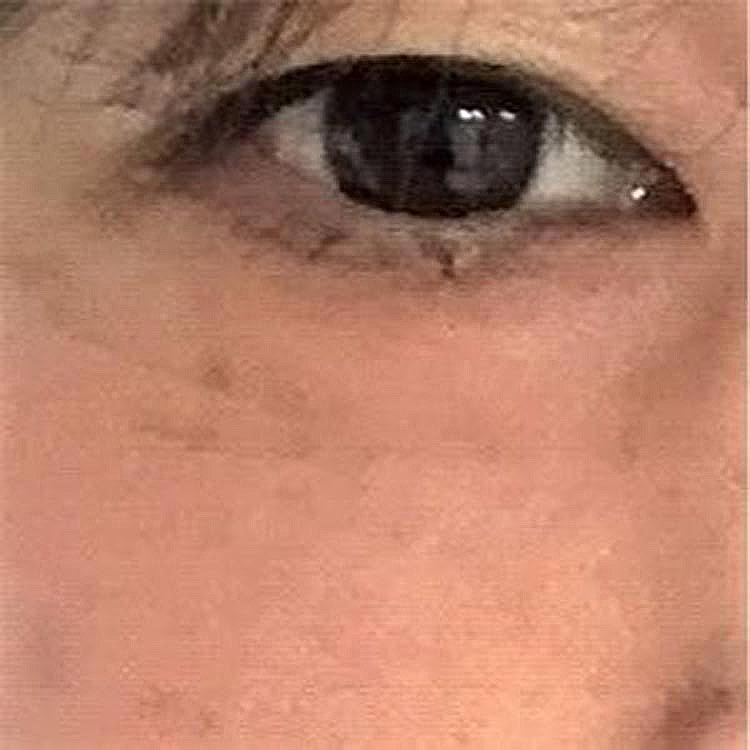 手術後1ヶ月
