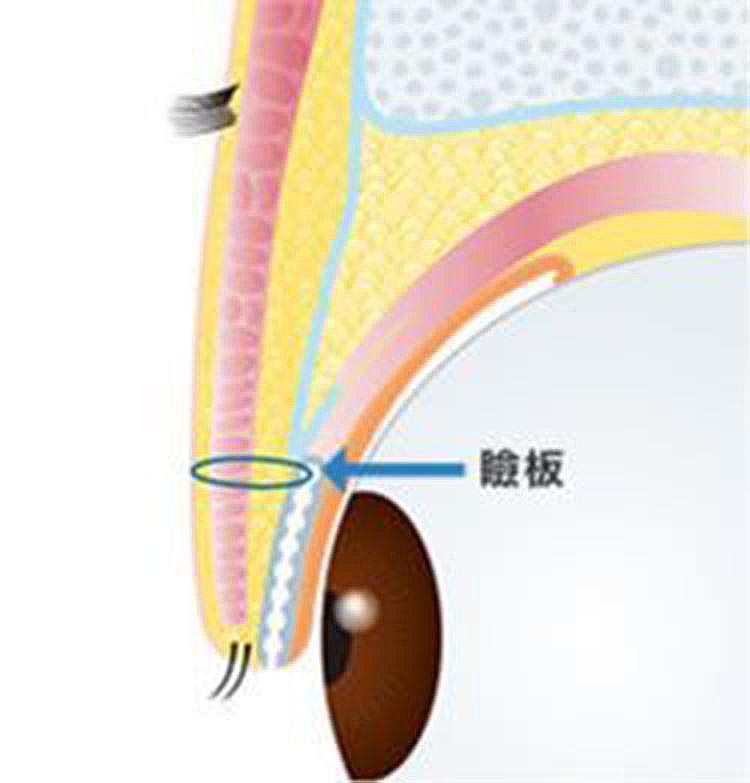 閉瞼時（目を閉じている）皮膚と瞼板を糸で固定