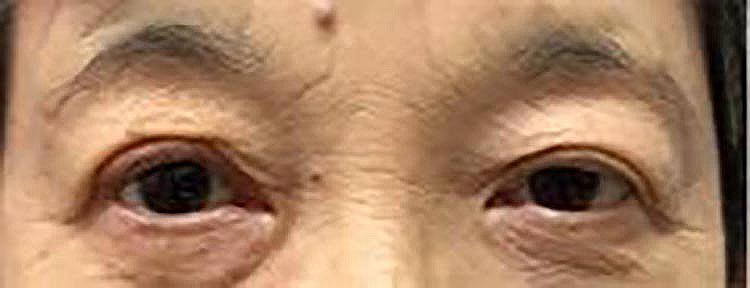 術後1週間（抜糸時）