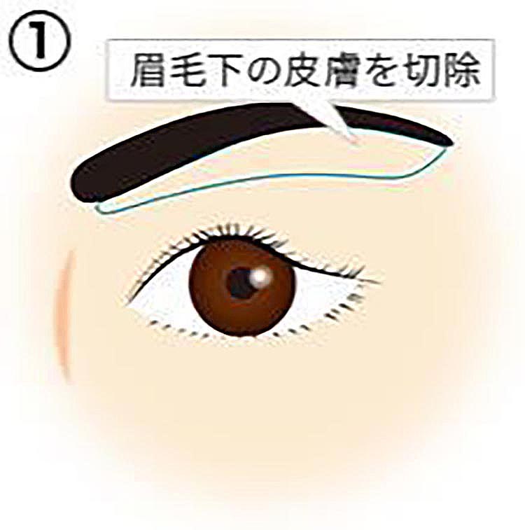 上瞼の皮膚がたるみ、眼球に皮膚が被っている