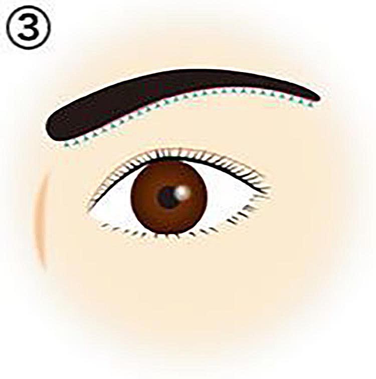 皮膚をリフトアップし、眉毛下で縫合する