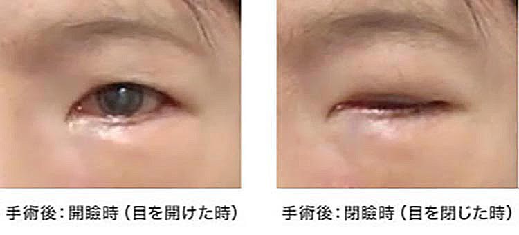 面神経麻痺