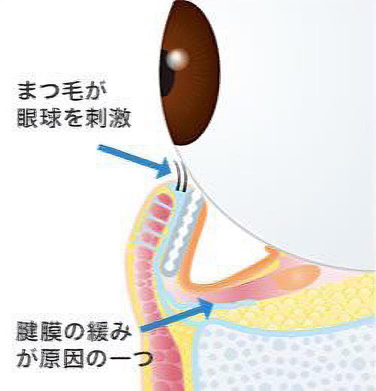下眼瞼内反の状態