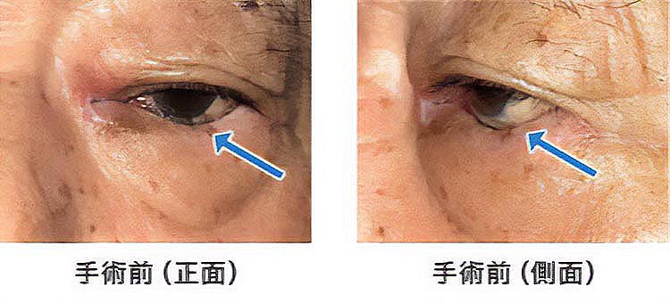 下まぶたが内反（眼球側に反転）し、睫毛が眼球表面を刺激しています。（矢印部分）