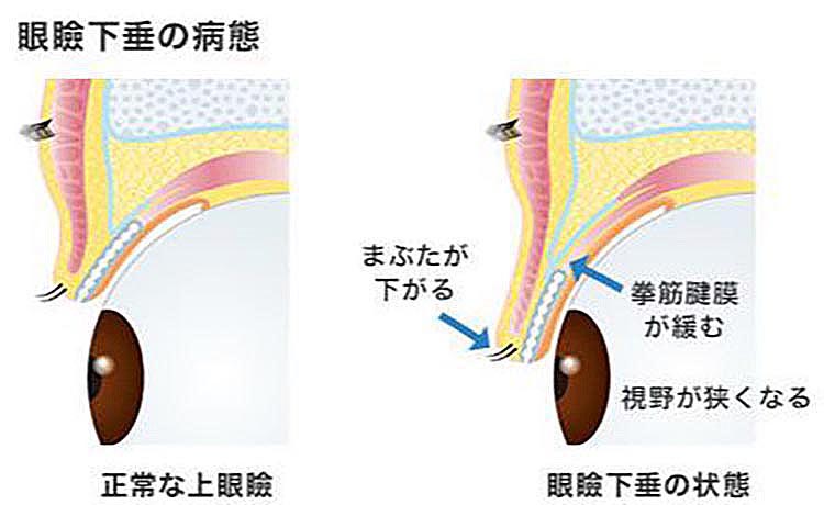 眼瞼下垂の病態