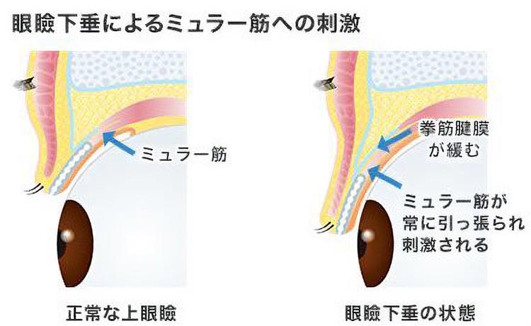 眼瞼下垂によるミュラー筋への刺激